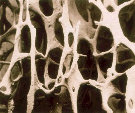 HumanKneads/osteoporosis.jpg